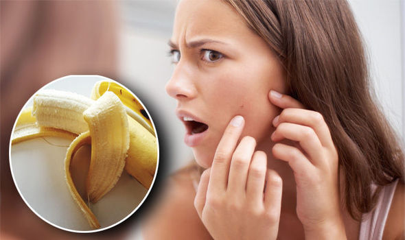 Banana peels can help you beneficially for acne