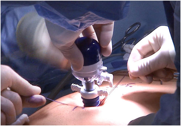 Laparoscopy: Treatment, Procedure, Cost