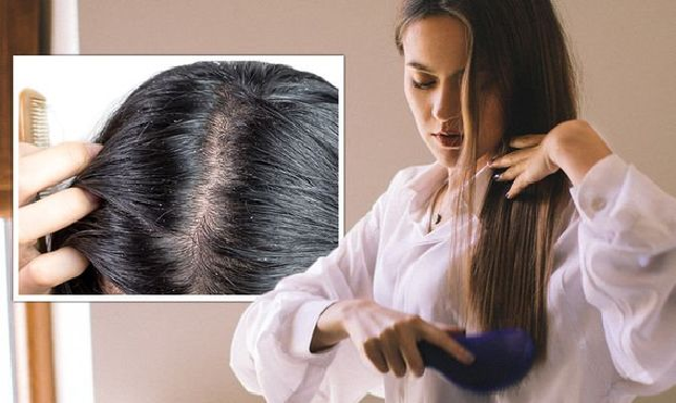 Can Dandruff Cause Severe Hair Fall