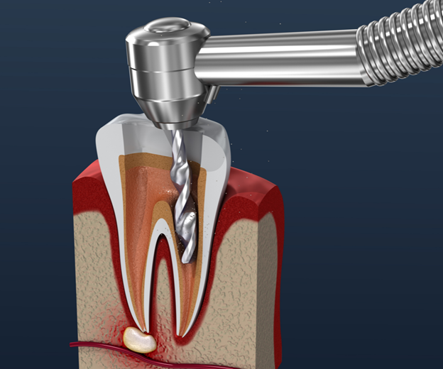 Afraid of Root Canal Treatment? Don’t be