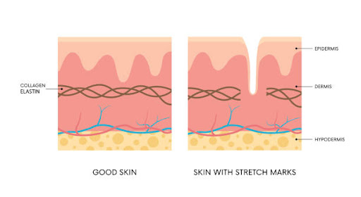 skin stretch marks