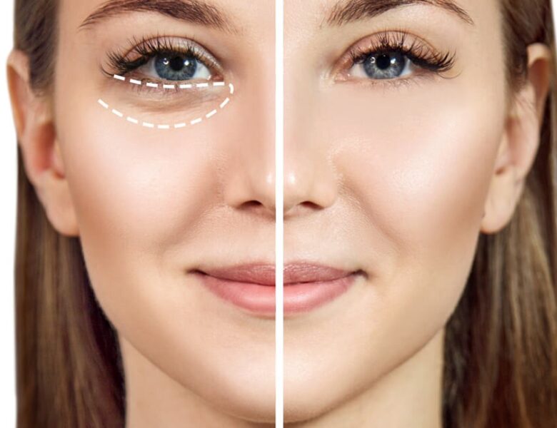 Way To Remove Under Eye Bags