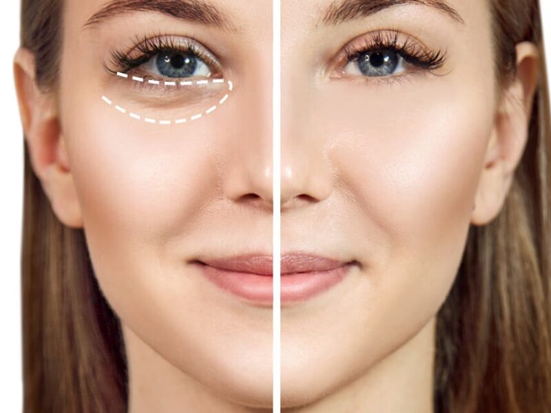 Way To Remove Under Eye Bags